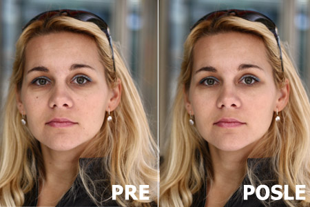 Pre i posle korekcija lica, fleka i podočnjaka